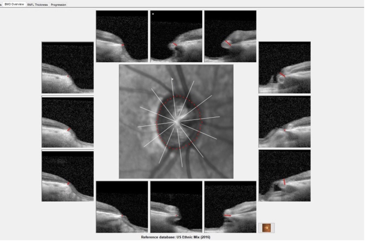 Radial optic nerve scans obtained at the 12 o’clock position with significant thinning of the neuroretinal rim from six o’clock through 12 o’clock in the right eye of the patient with more advanced structural damage.