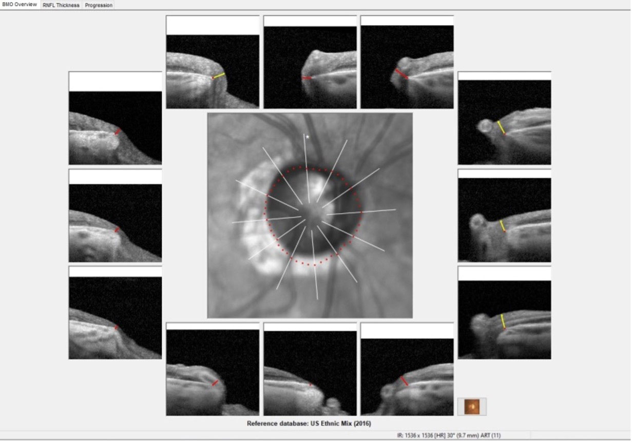 Erosion of the temporal neuroretinal rim in the right eye of the other patient.