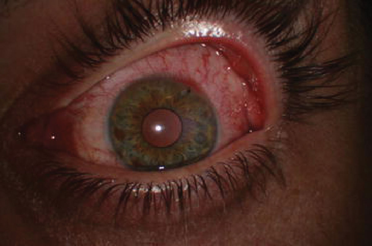 Fig. 1. Preoperative slit lamp biomicroscopy of the patient’s left eye shows the embedded corneal foreign body.