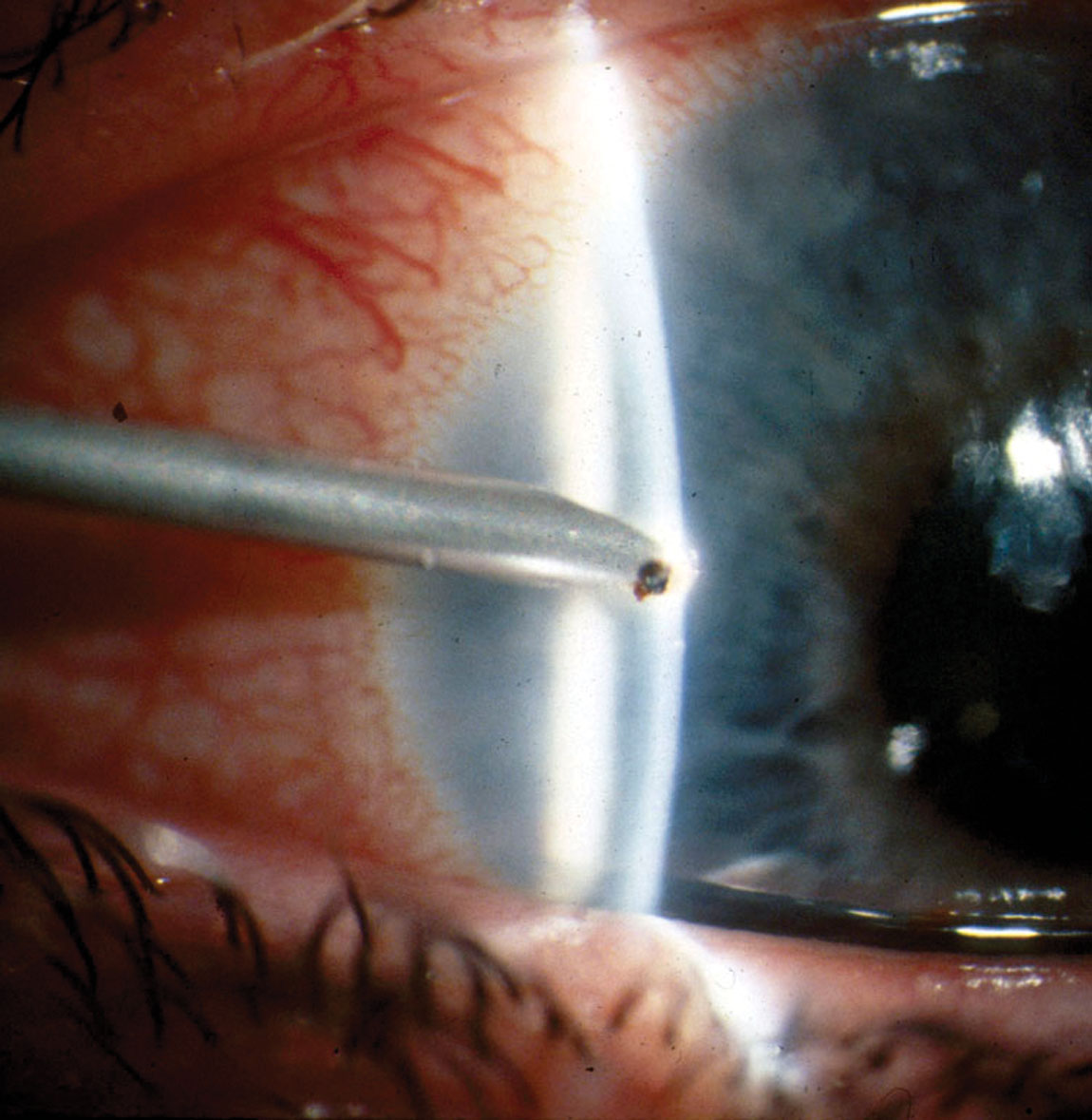 Fig. 4. Spud removal of a metallic foreign body.