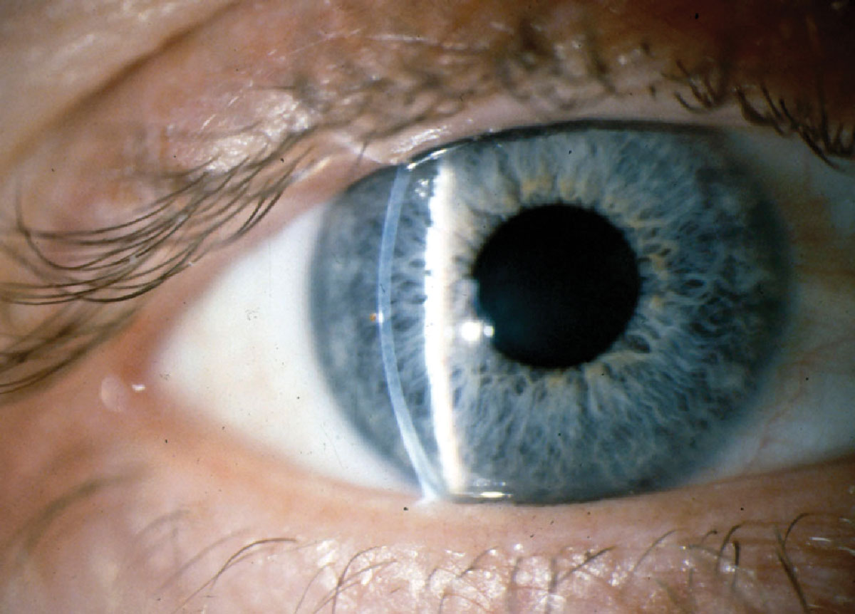 Fig. 7. Healed epithelial defect with trace remaining rust seen at foreign body removal follow-up.