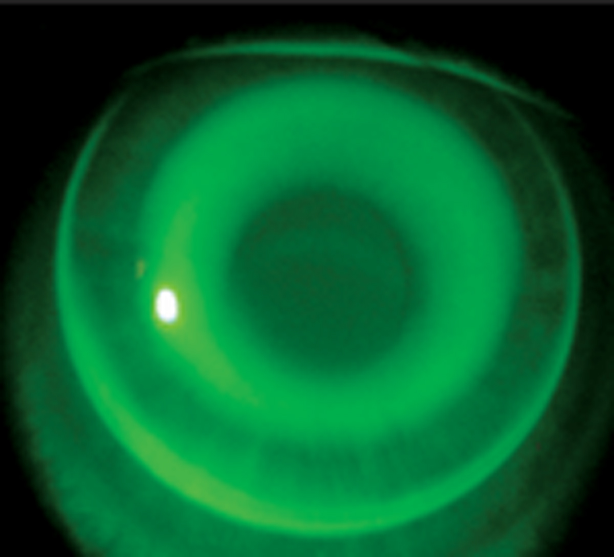 Treatment zone decentration aids in slowing myopia progression in patients wearing ortho-k lenses. 