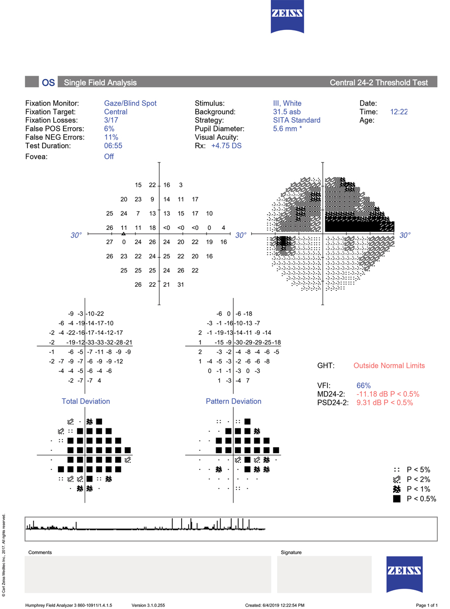 24-2 visual field tests may not be the best choice for detecting early signs of glaucoma, study finds.