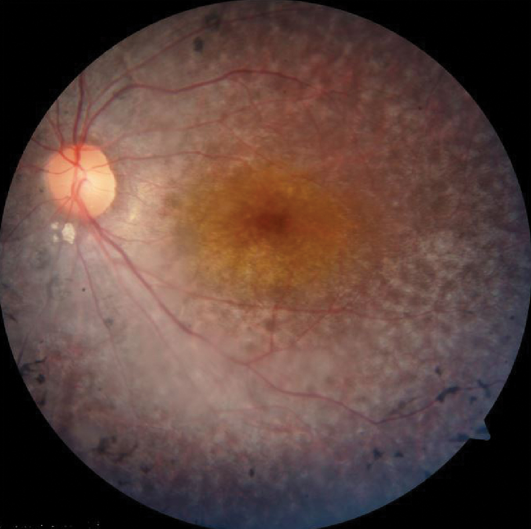 RP with arteriolar attenuation and bone spicules. Note the peripheral retinal loss with central island of sparing.