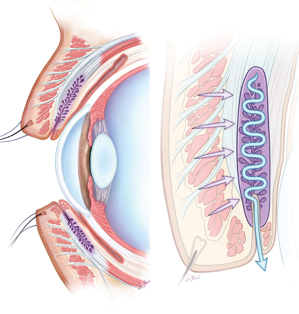 Fig. 8. The role and dysfunction of meibomian glands in dry eye.