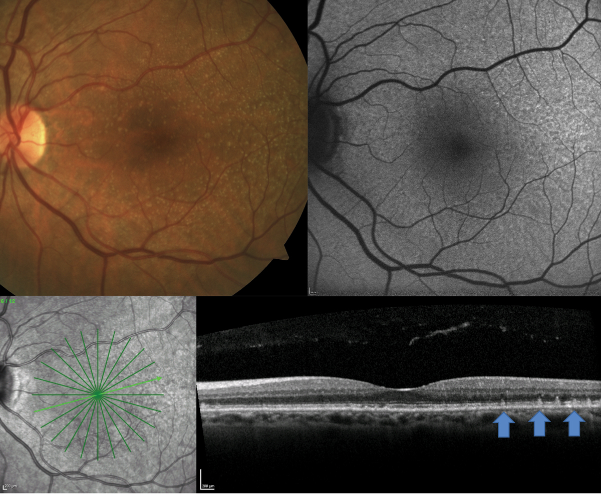 Excess risk associated with reticular pseudodrusen varies by disease severity.