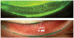 Contact lens users may be more likely to have OSD effects due to the friction caused by blinking.