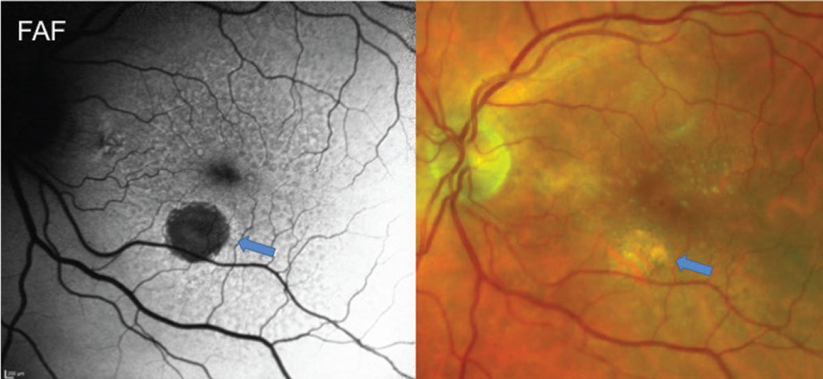 This study determined that the presence of reticular pseudodrusen carried a higher risk for GA than nAMD.