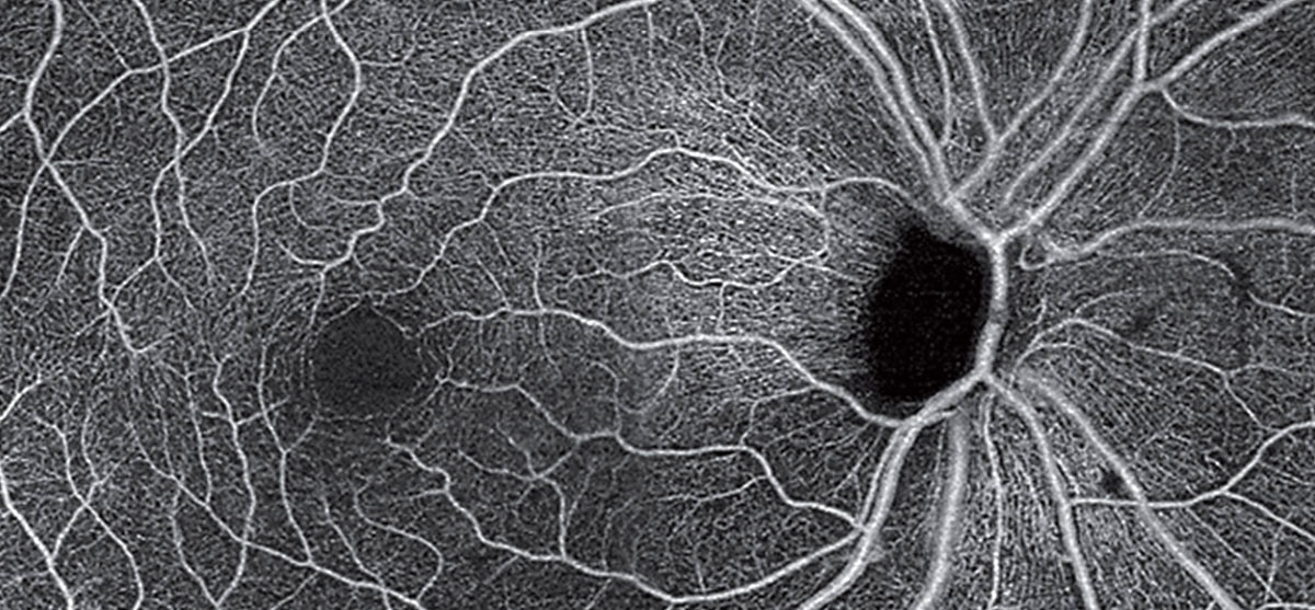 OCT-A montage of an unrelated patient (with POAG) showing loss of radial peripapillary capillaries and the superficial capillary plexus.