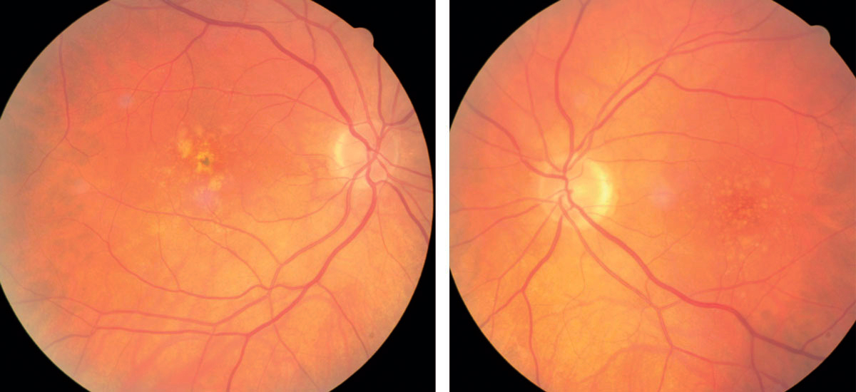 Supplements with lutein/zeaxanthin effectively reduced AMD and cataract risk in older adults in this study.