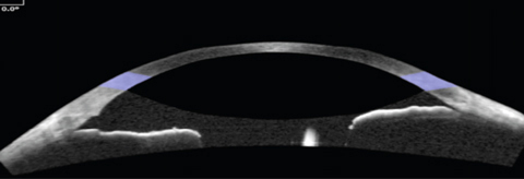 Ethnic differences should be considered when assessing anterior chamber depth in a candidate for cataract surgery.