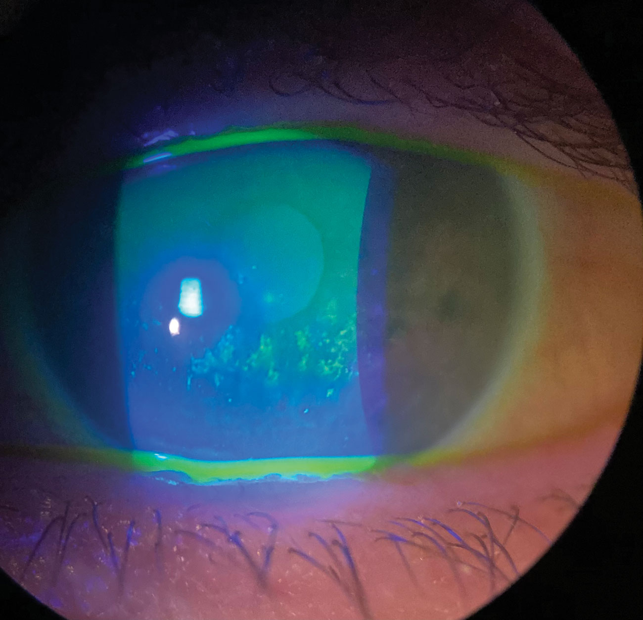 This study identified no difference in dry eye severity between those who supplemented with omega fatty acids and those who didn't.