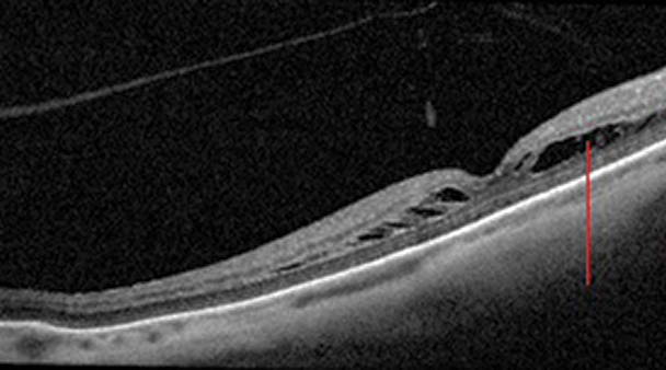 Foveoschisis in a high myope similar to those studied. EMSSRD gives the appearance of a macular hole.