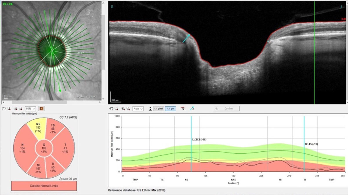 This study identified a number of predictive factors for an elevated IOP, including older age, abnormal blood pressure, diabetes and people who've had cataract surgery.