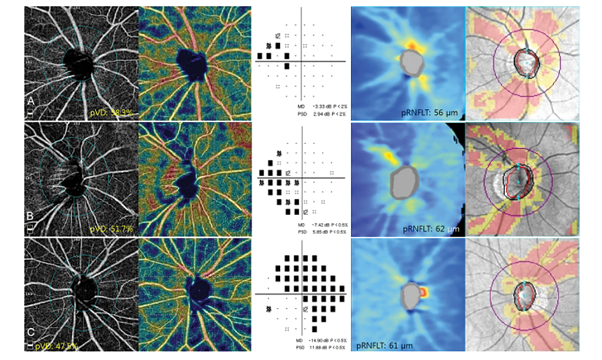 This study observed that vessel density measurements in peripapillary sectors are lower in eyes with a tilted disc.