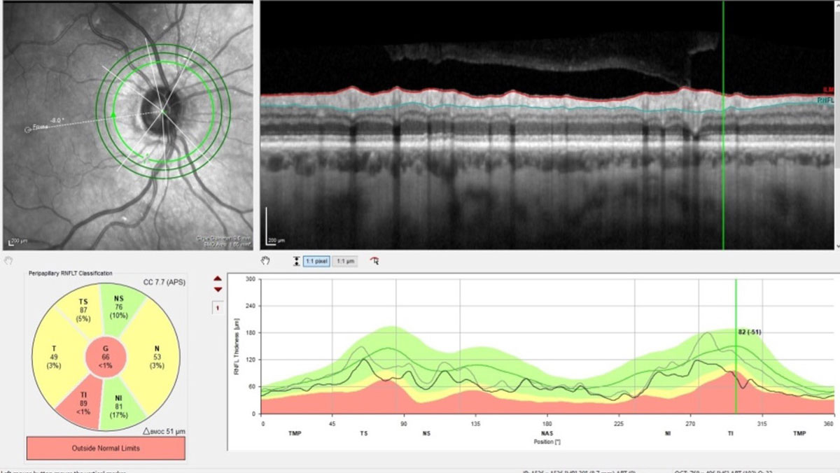 Recet studies provide stronger evidence on OCT’s diagnostic utility in detecting cognitive decline.