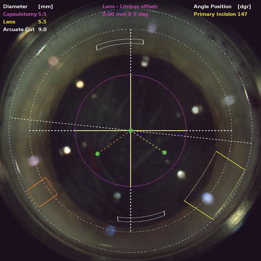 FLACS may be a better choice than conventional phaco for patients with hard cataracts, study finds.