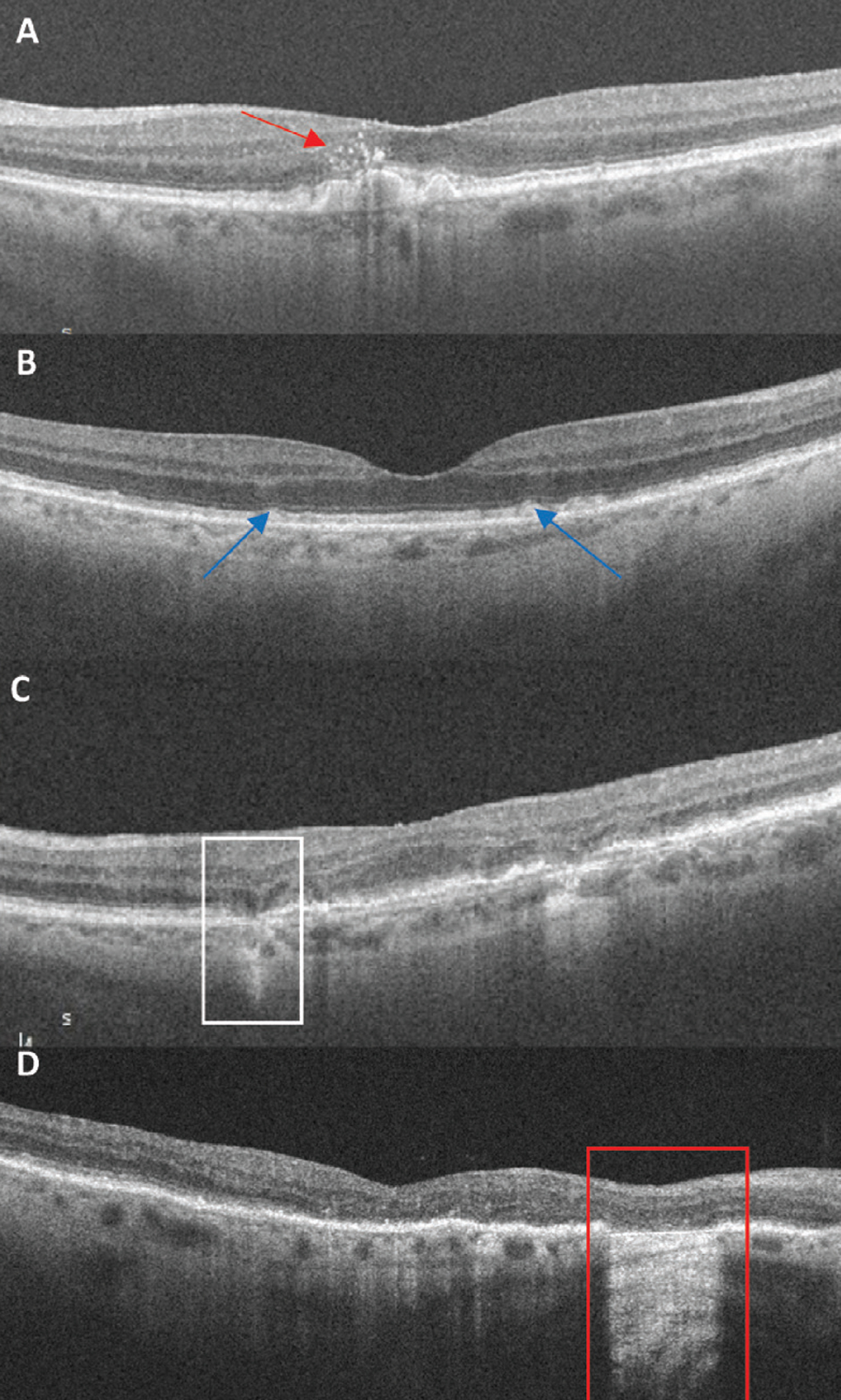 Fig. 3. OCT biomarkers: (A) Red arrow points to numerous hyperreflective foci located above large drusen. (B) Blue arrows indicate subretinal drusenoid deposits, a granular elevation below the EZ. (C) The white box highlights an area of iRORA. There is a subsidence to the OPL and INL with a hyporeflective wedge-shaped band to the OPL. There is attenuation to the RPE with a hypertransmission defect. (D) The red box indicates an area of cRORA. Note the loss of the EZ and RPE with subsequent hypertransmission defect of 607µm in width.  