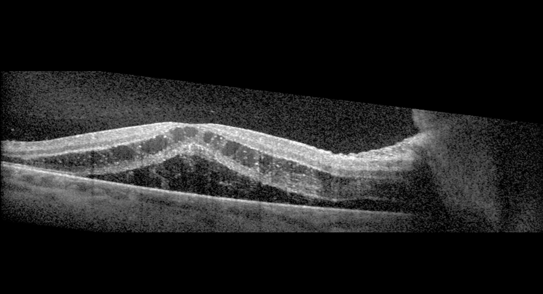 Figure 3. OCT of the right eye: significant cystoid macular edema and serous macular detachment.