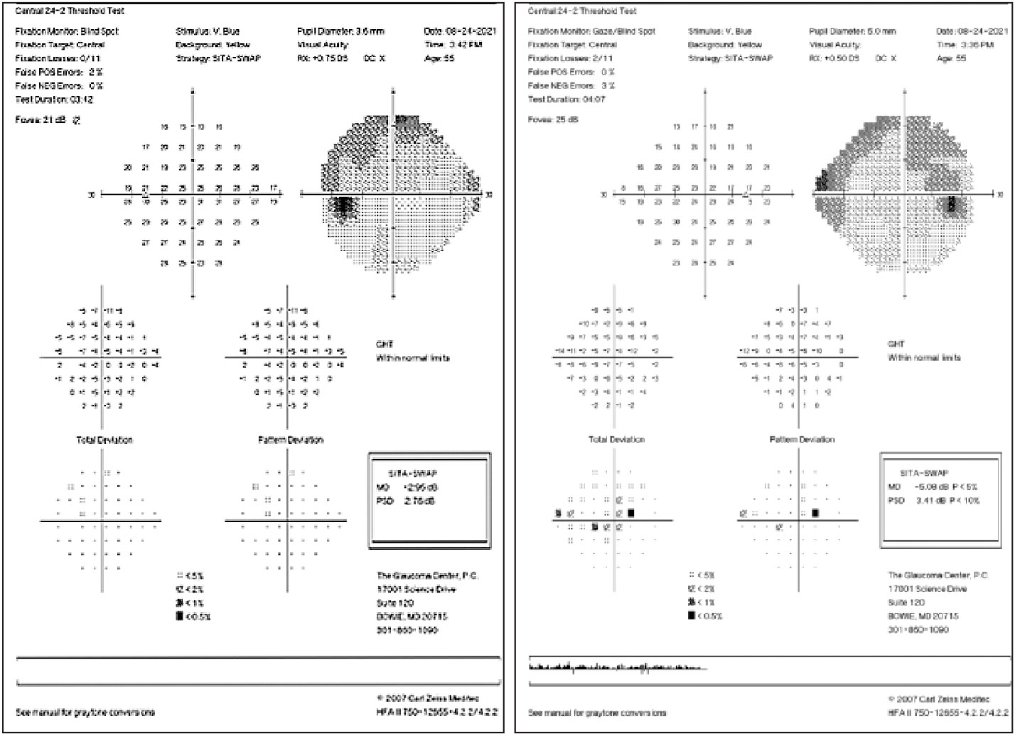 SITA SWAP testing helps display early glaucomatous defects.