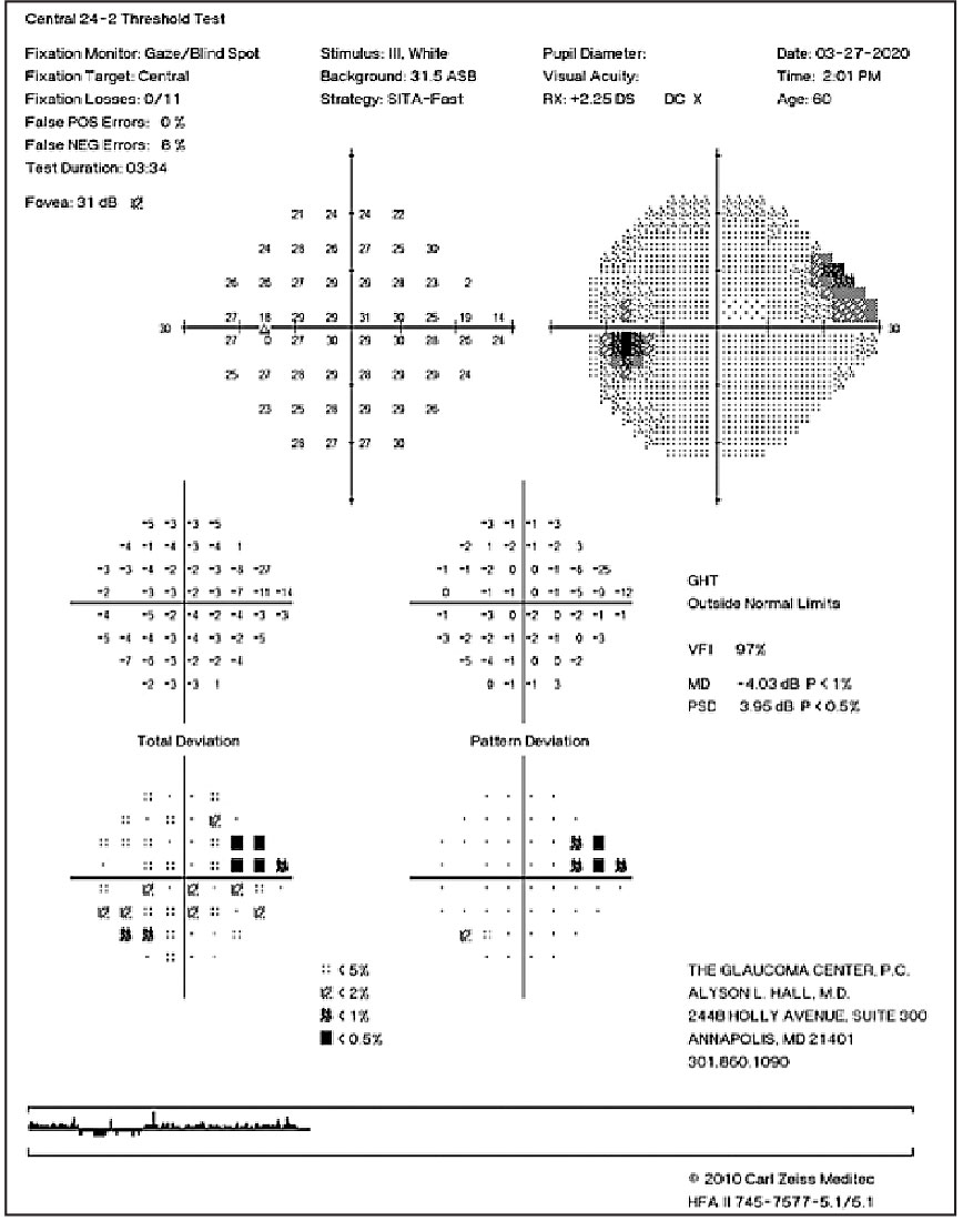 Superior nasal step in a patient with moderate glaucoma.