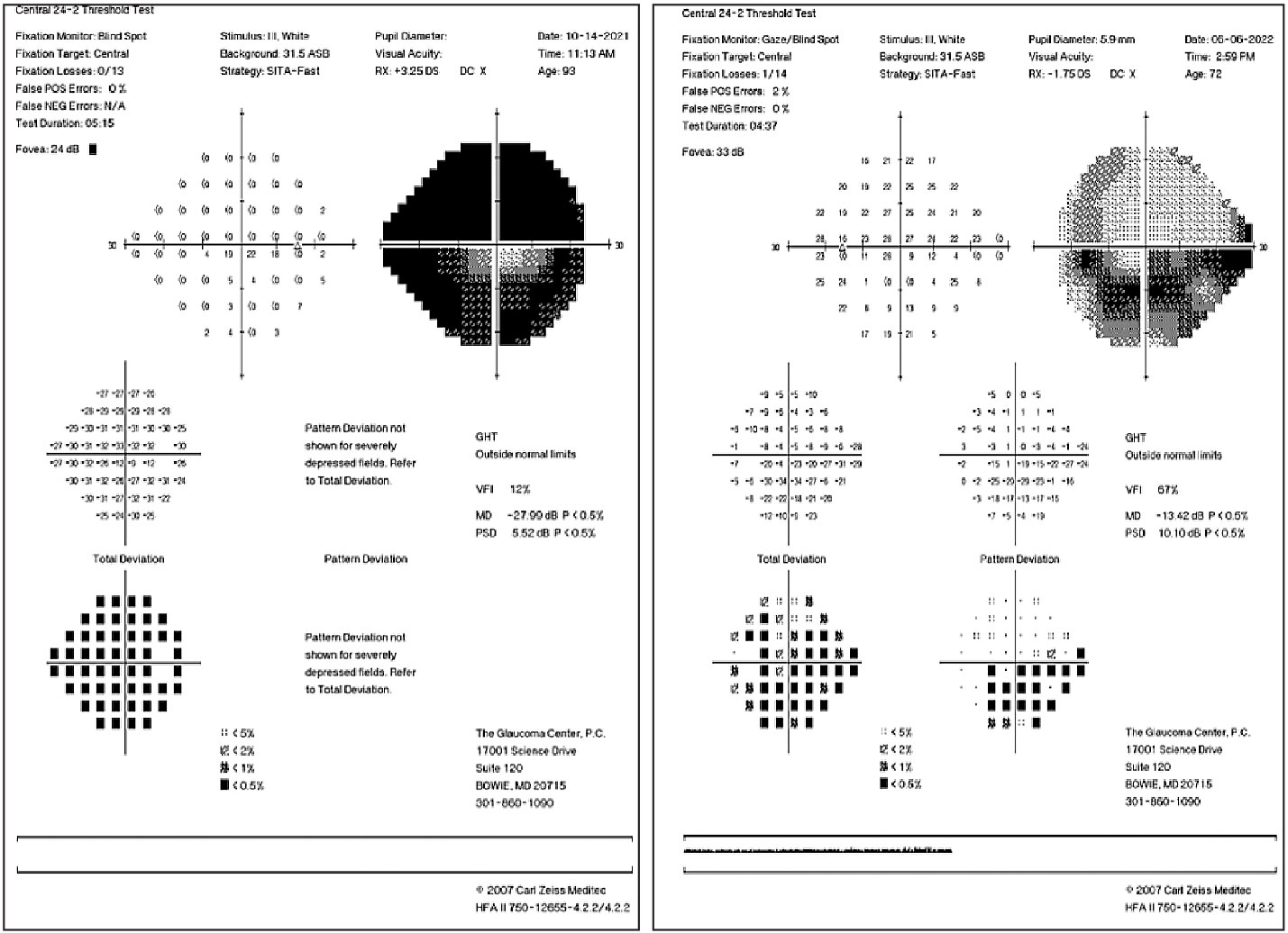 Dense superior and inferior arcuate defects in an advanced glaucoma patient (left). Inferior arcuate defect involving fixation and early superior nasal step (right).