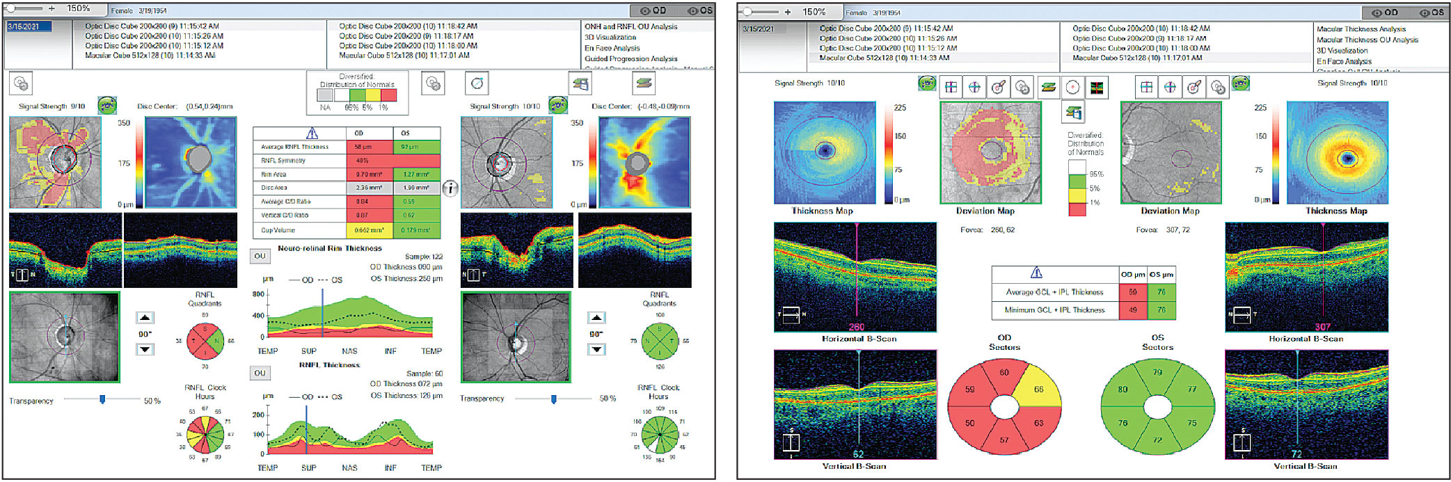 Left: Severe glaucomatous optic nerve damage of the right eye with a very thin RNFL, which may not show further thinning past this point. Right: Macula ganglion cell complex, which can help provide information about progression in the same individual.