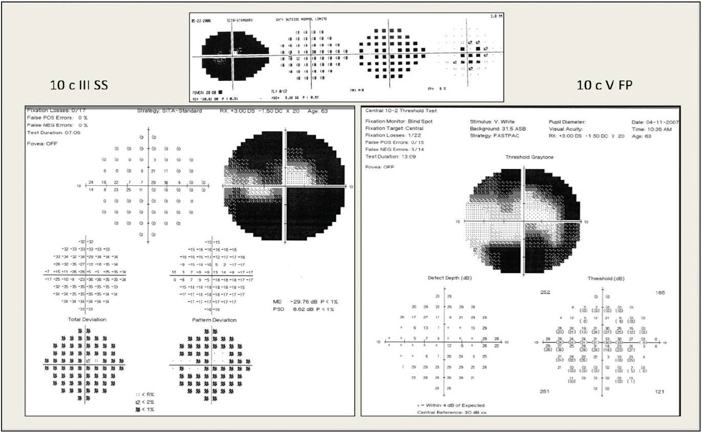 Pictured here is 24-2 testing (top) and 10-2 testing (bottom left). Fastpac size V stimulus testing allows for better monitoring of the central remaining points (bottom right).