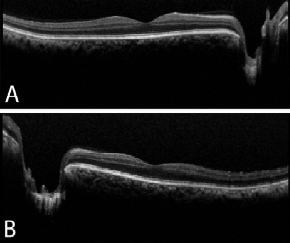 OCT of the right (A) and left (B) eyes reveals no macular edema or retinal thickening. There is deep cupping in the left eye greater than the right eye, which corroborates with the fundus exam.