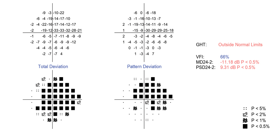 Ethnicity may play a role in incidence and timing of vision loss among patients with POAG.