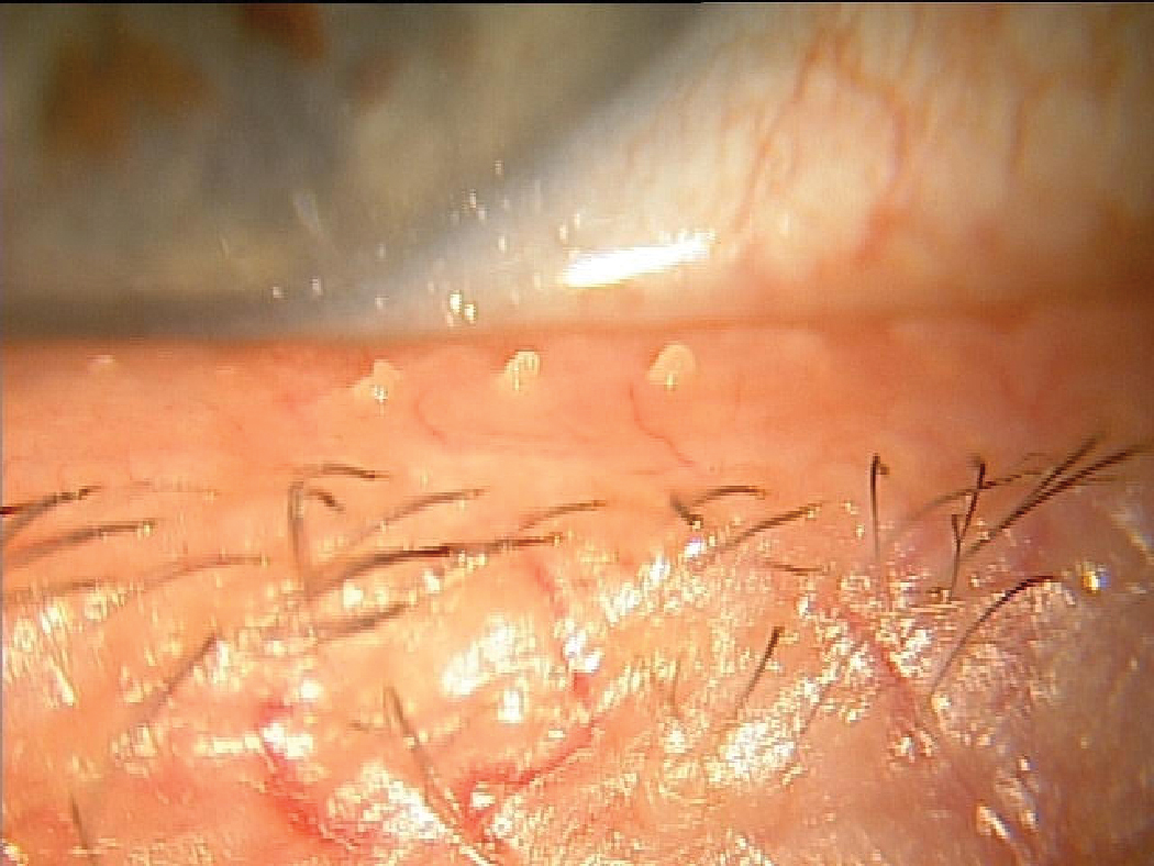 Another MGD patient that likely suffers from chronic tear instability resulting from inadequate lipid release to the ocular surface.