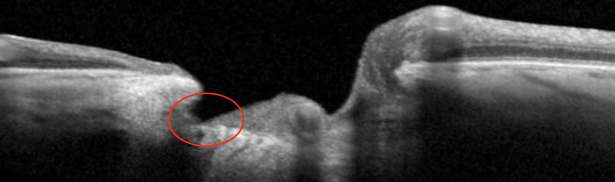 Loss of prelaminar neural tissue in a patient with myopic glaucoma.