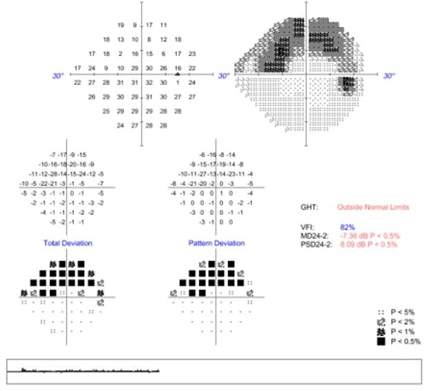 Superior arcuate defect in a patient with moderate glaucoma.