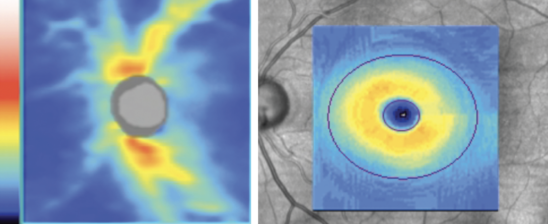  It’s important to analyze all tissue that can be affected by glaucoma, which includes both the optic nerve head and the macula.