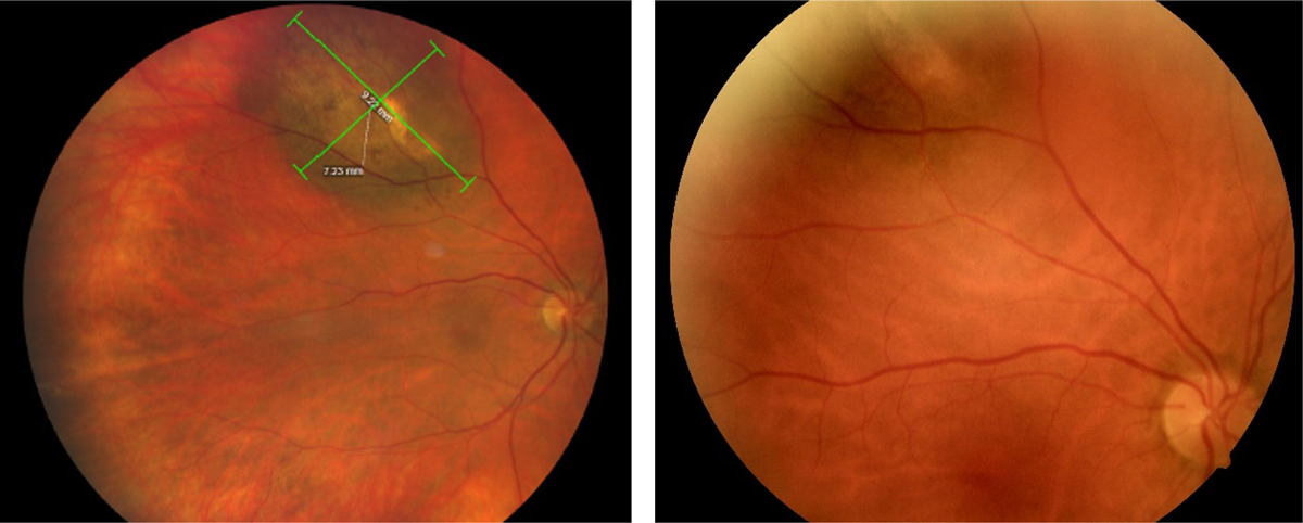 This study identified ciliary body involvement, male sex, patient age at diagnosis, tumor diameter and monosomy 3 as independent prognostic factors for metastasis.