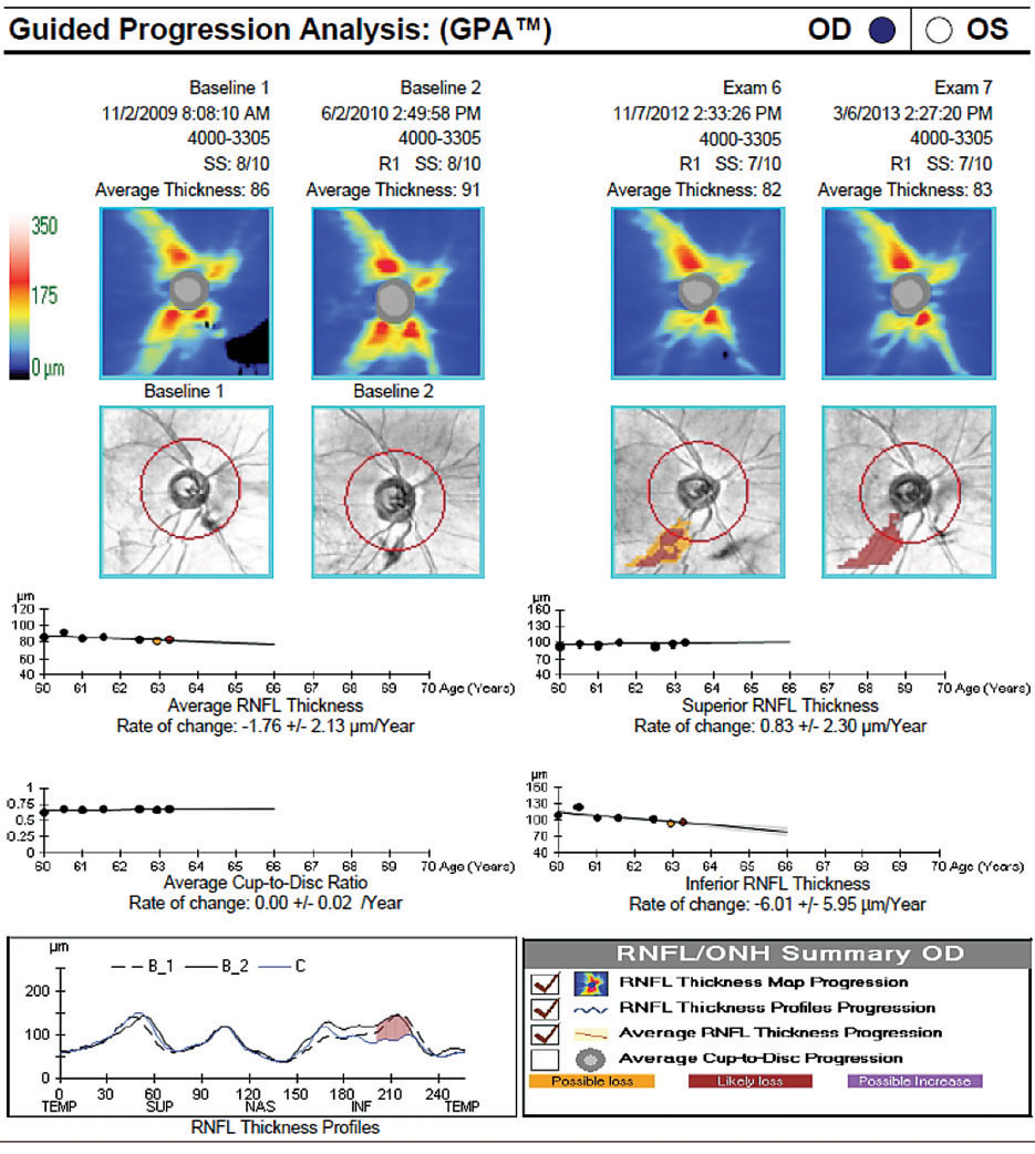 Obstructive sleep apnea may not affect the corneal nerves, but it was associated with RNFL thinning.