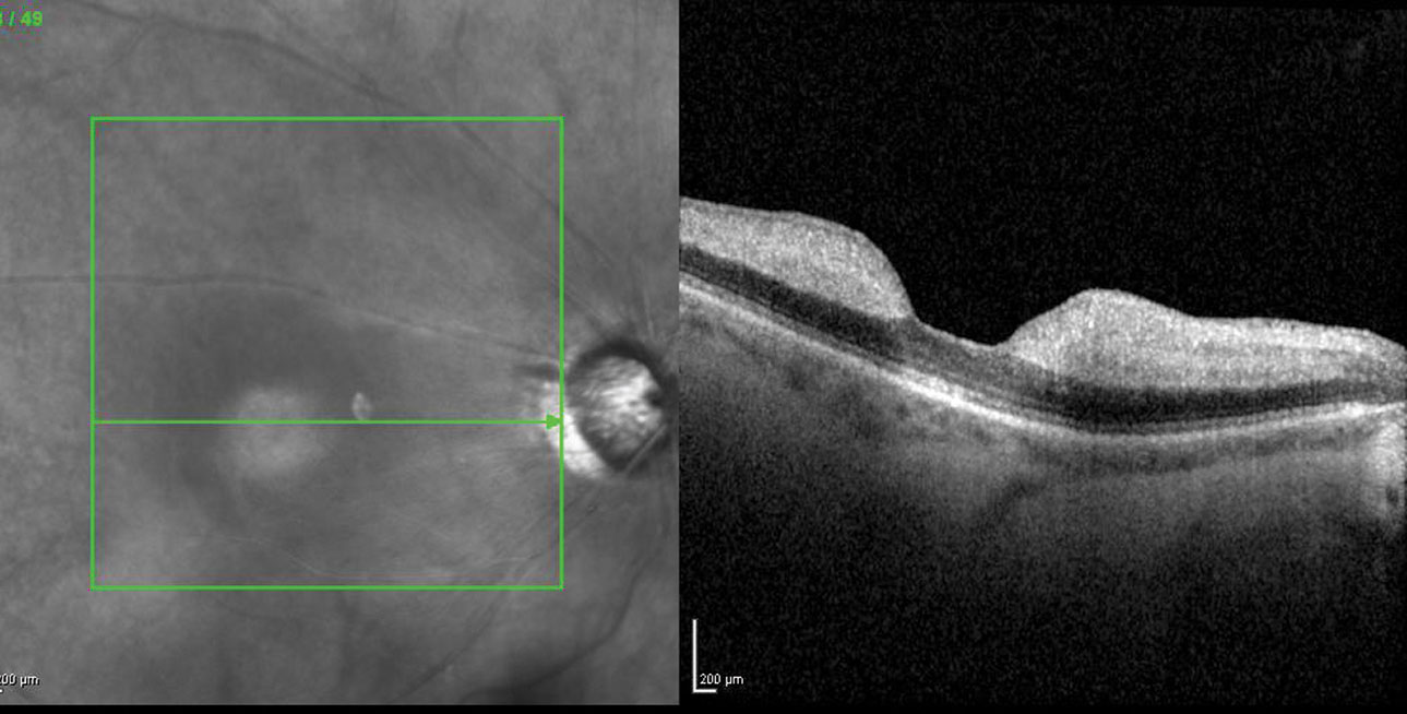 Significant changes in either intraocular pressure gradients or hemodynamics predispose patients to RAO.