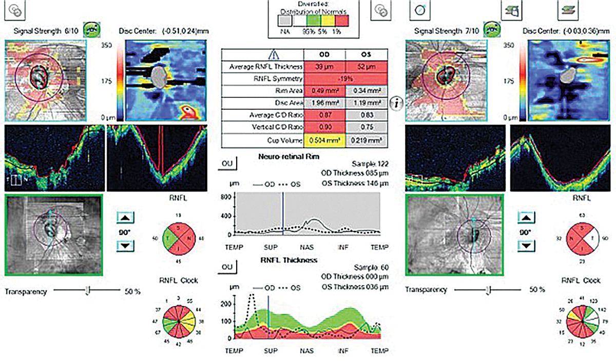 Conventional OCT metrics may yield false positives (so-called red disease) in high myopes. 