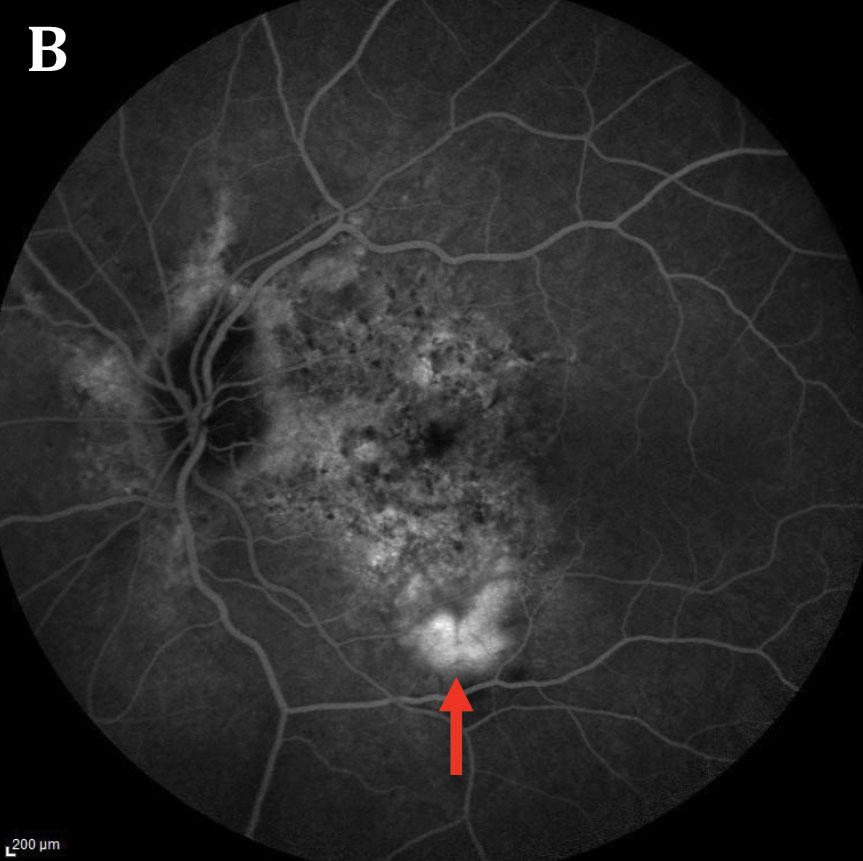 Anti-VEGF was observed to be an effective treatment in patients with CNV associated with angioid streaks.