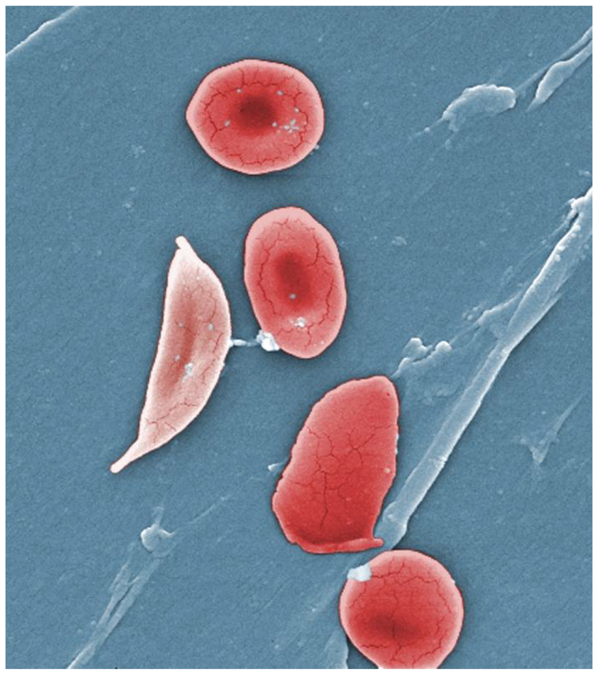 Using OCT-A and another imaging modality called AOSLO allows for the identification of sickle cell disease. 