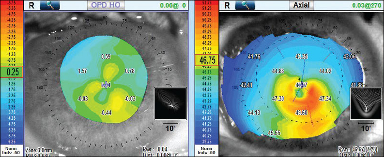 Patients who had a low birth weight may be more likely to experience corneal aberrations, study suggests.