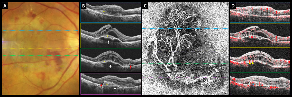 Patients taking metformin over a two-year period were approximately 5% less likely to develop AMD.