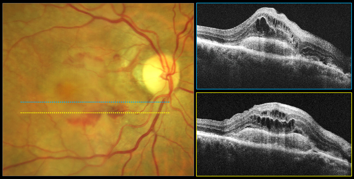 Once patients go from early to intermediate AMD, this study found that dark adaptation seems to significantly worsen. 