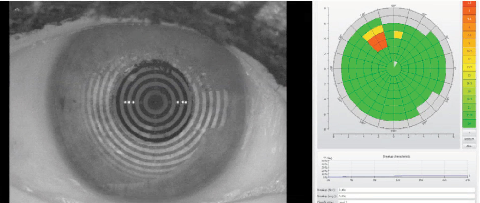 Noninvasive tear breakup time as measured by the Oculus Keratograph. This patient’s first time measured at 2.48 seconds with an average of 6.83 seconds.