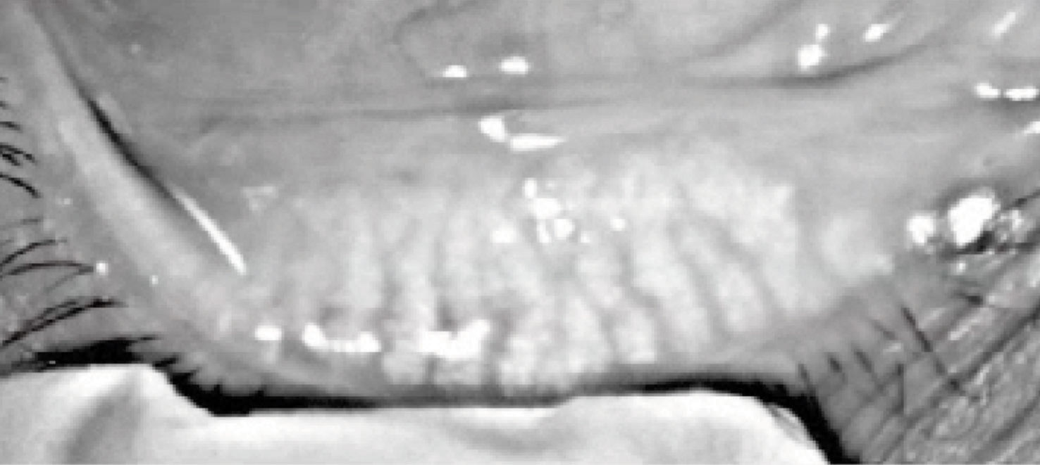 Meibography of the right lower meibomian glands showing atrophy, dilation and truncation of the glands.