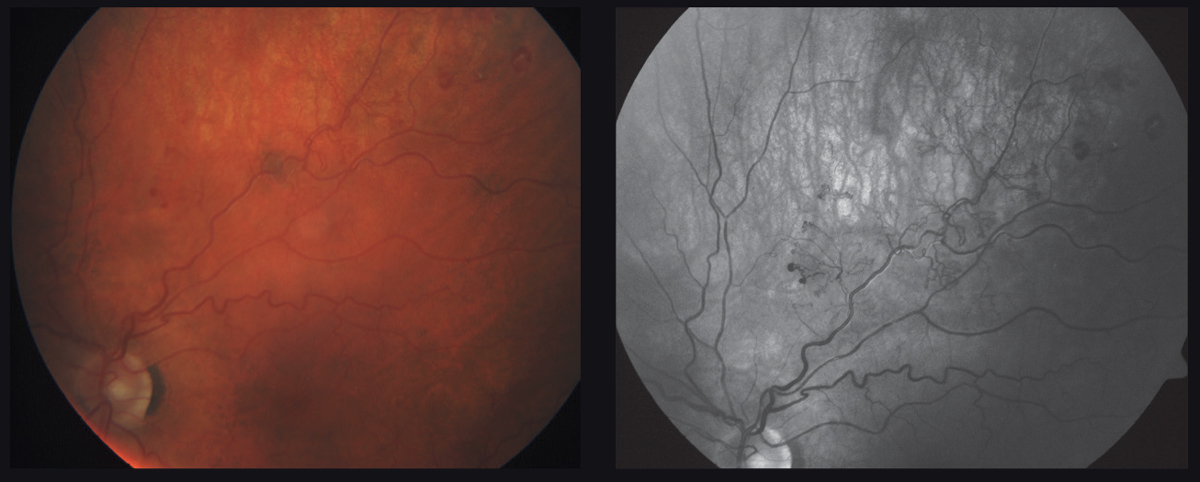 Among other factors, vascular density may be an important predictor of outcomes following BRVO.