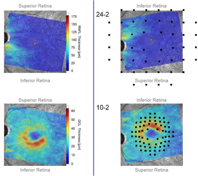 Early glaucoma patients may undergo visual system adaptation that preserves normal binocular summation.