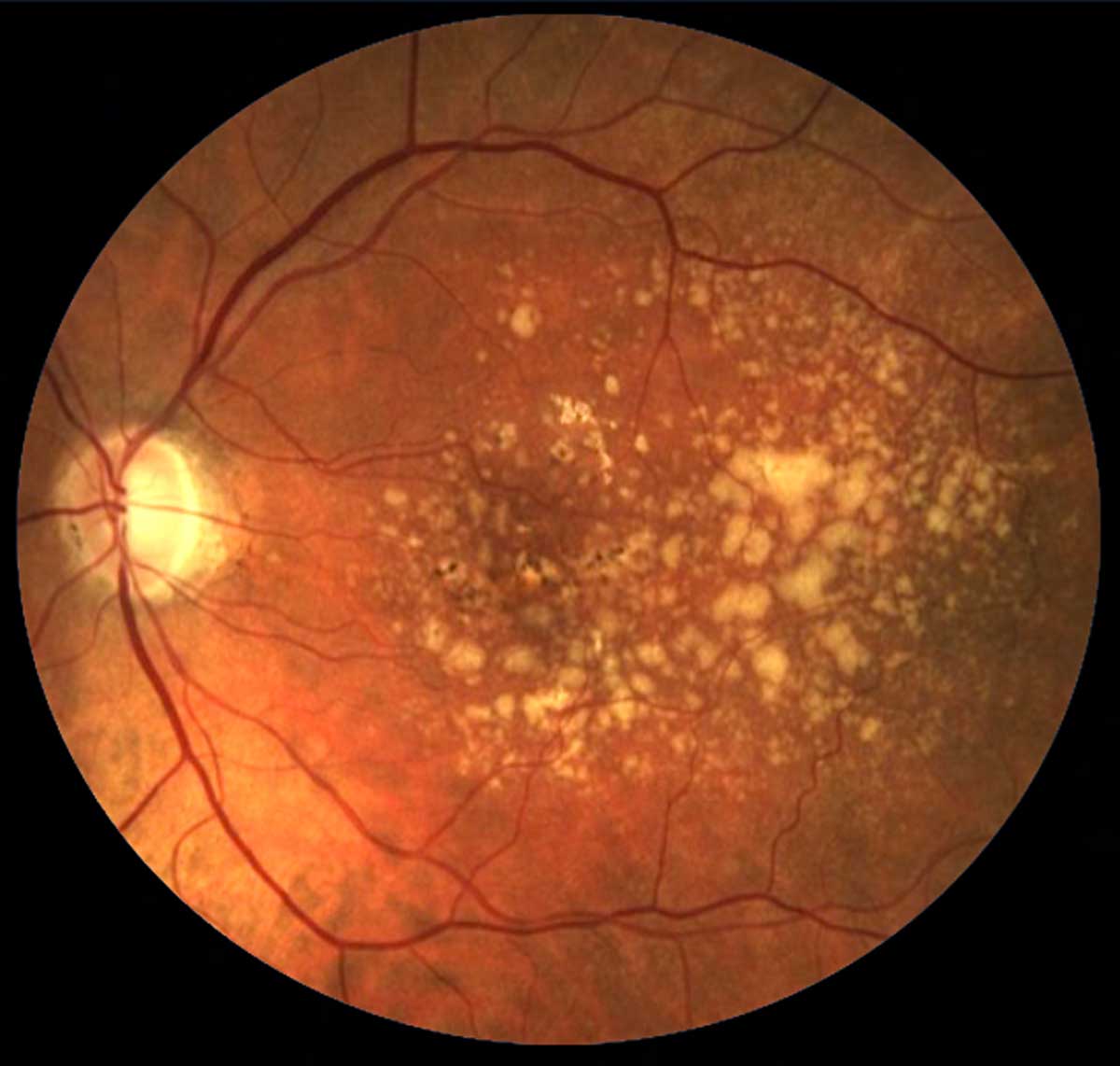 Increased follow-ups and closer monitoring may be why AMD patients on anti-VEGF therapy don't seem to have greater glaucoma progression.