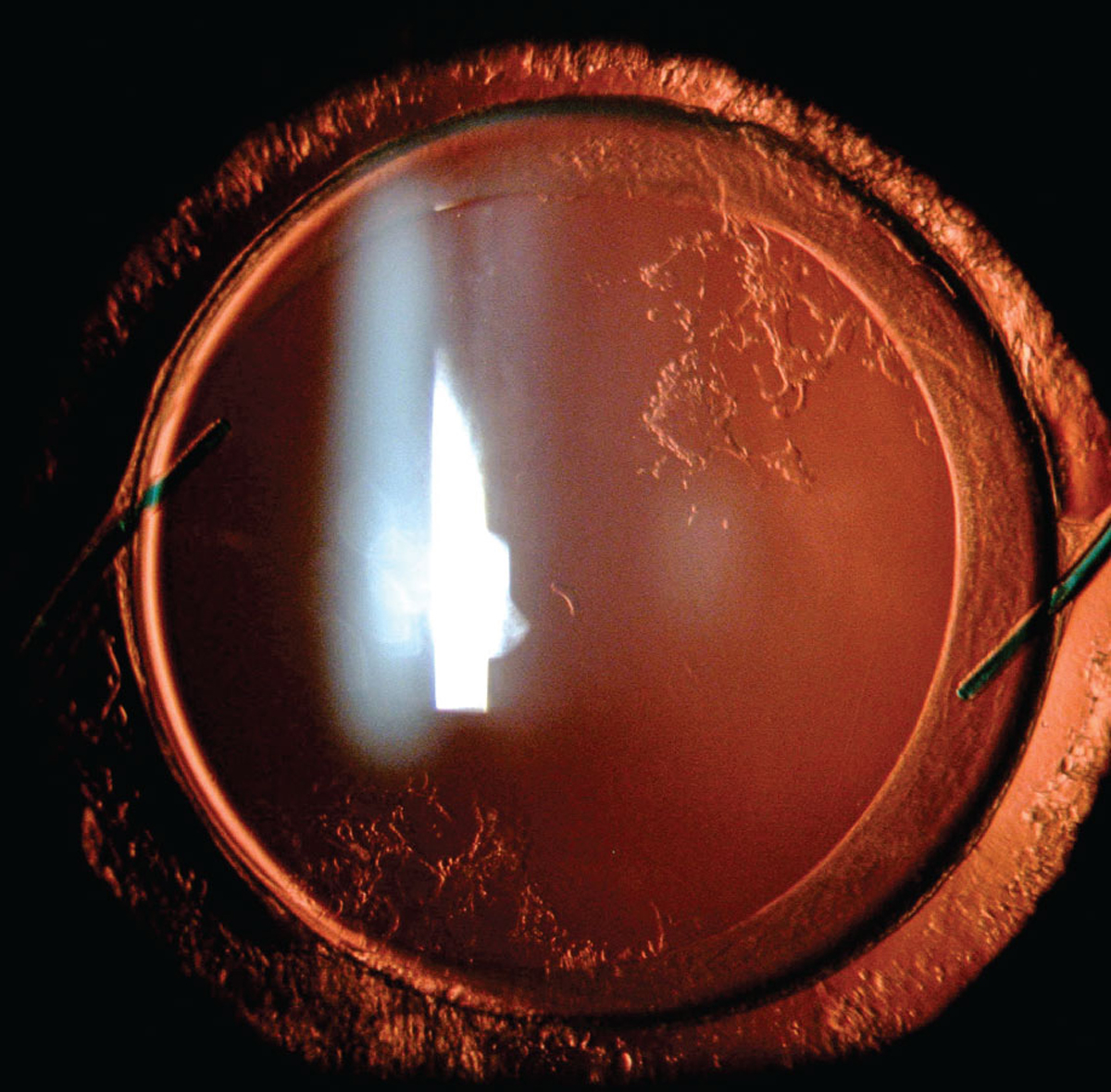 This study identified several risk factors for post-cataract PCO.