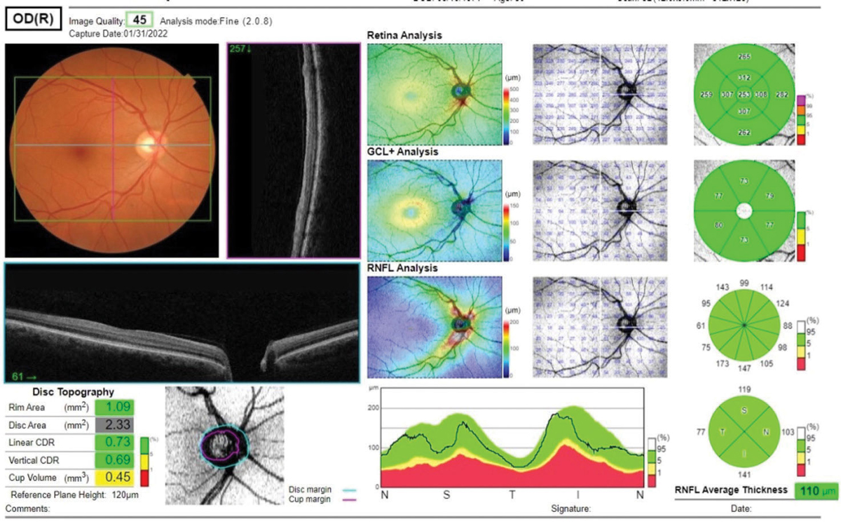 Monitoring the vertical cup-to-disc ratio may aid in assessing non-glaucomatous eyes.